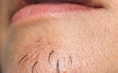 A woman’s chin hair is a sign of…See below