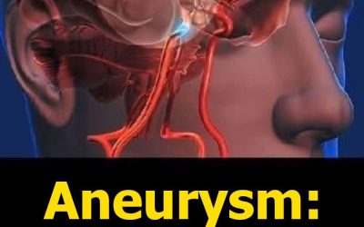Aneurysm: Signs You Shouldn’t Ignore…